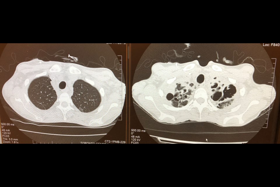 The image on the left shows Natalie Daoust's new donor lungs. The image on the right is  of her old lungs ravaged by cystic fibrosis.