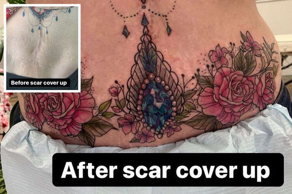 Mastectomy Scar Art - Breast Cancer Survivors Heal through Digital