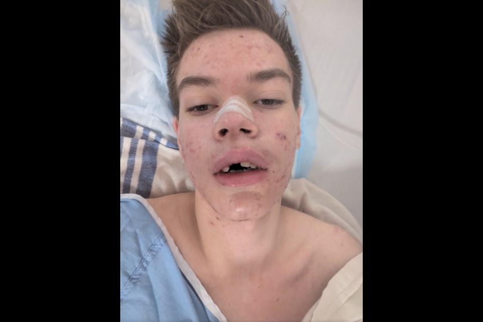 Cash Knowlton after undergoing surgery to repair a broken nose and jaw he suffered after crashing an e-bike into a tree.