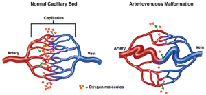 6856Arteriovenous_Malformation_pic_1