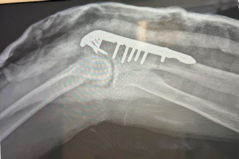 X-ray of plate put in McKinley-Molodynia’s elbow before she will compete in her first Ironman.