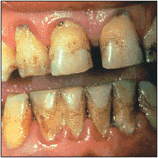 periodontitis