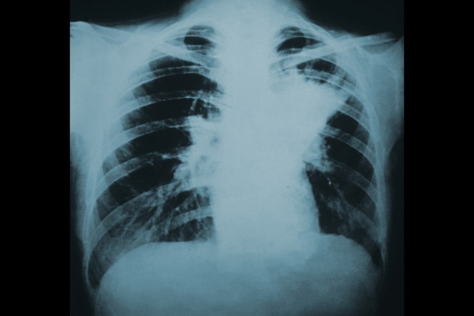 070624_cdc-blastomycosis_lung_infiltration