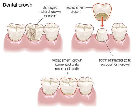 dentist crown recommended so next sootoday cap