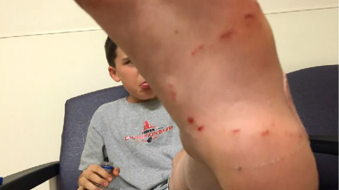 Ouch! Hungry muskie takes bite of Sudbury boy's foot (photos